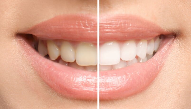 Before and After Whitening Results